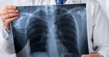 health & wellness 1119, lung cancer